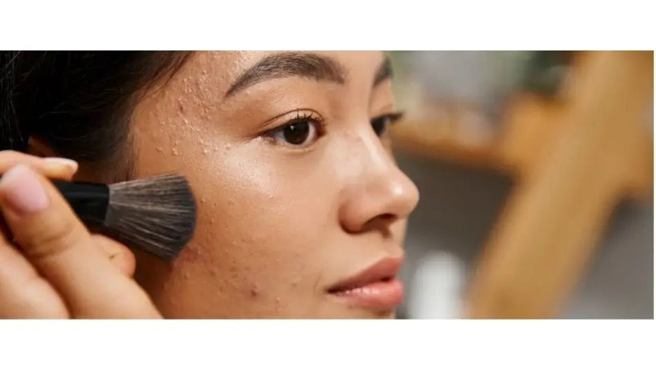 Handling party season breakouts with Hero Pimple Patches