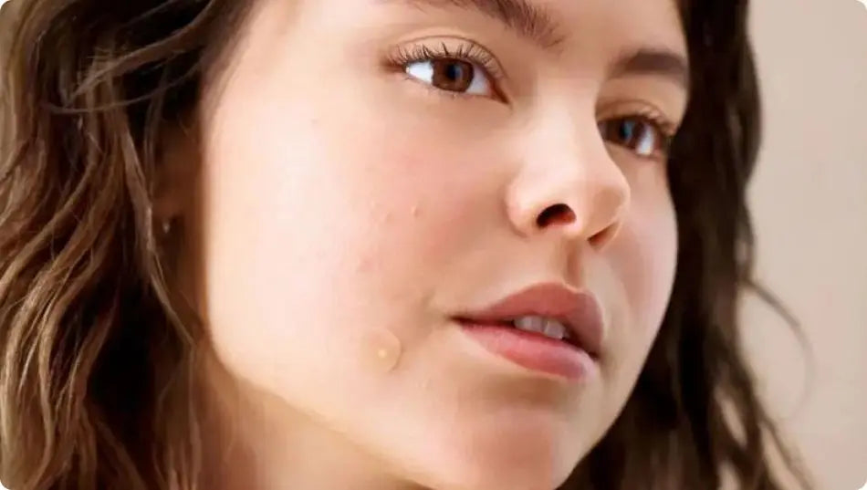 Pimple Patches 101: How do spot patches work? | Hero Cosmetics