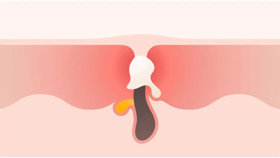 How A Pimple Forms & How To Treat It