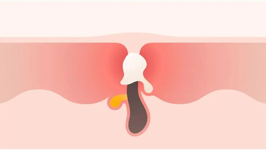 How A Pimple Forms & How To Treat It